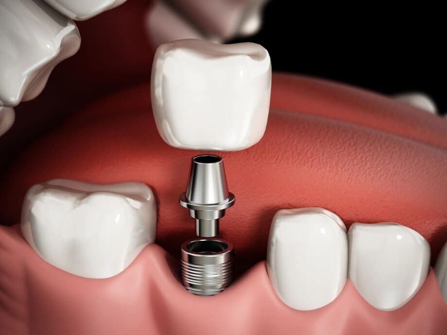 dental implant crown