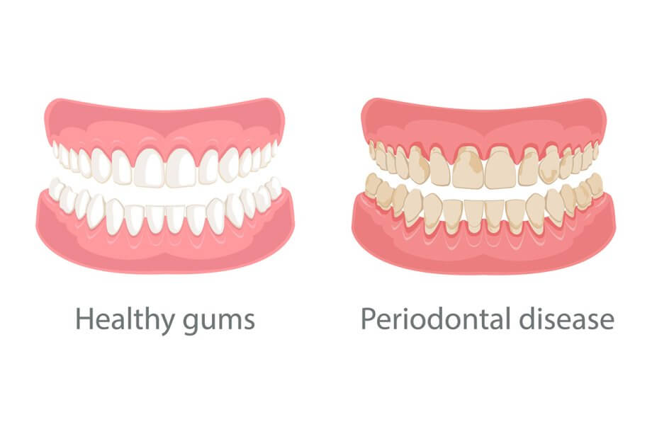 What Causes Periodontal