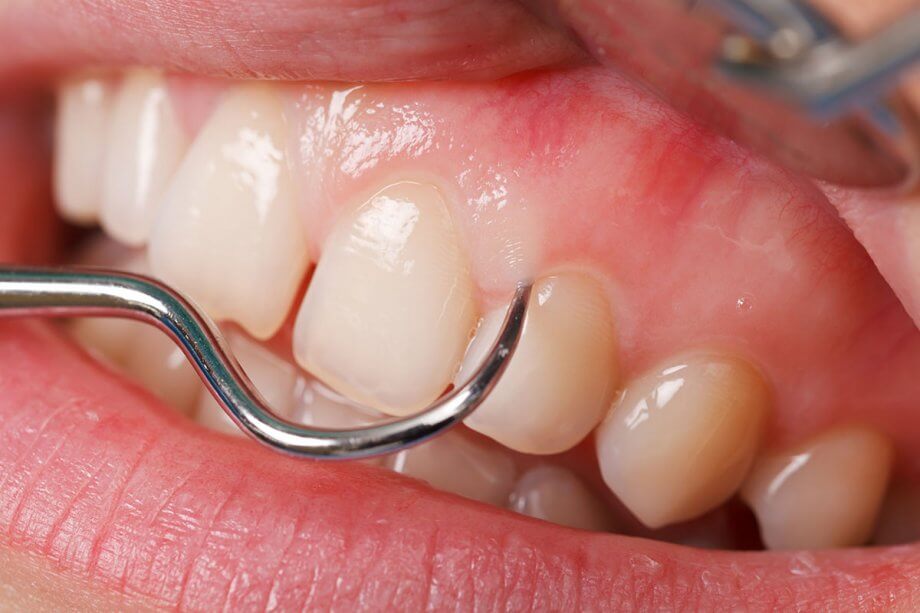 Indications for Gingival Grafting