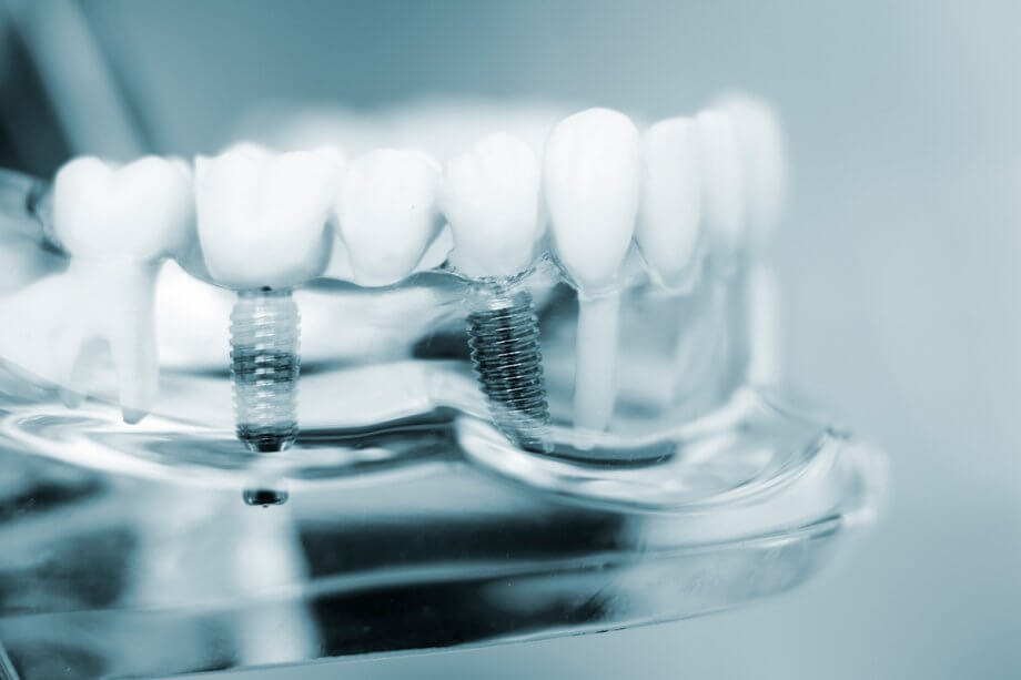 How Long Do Dental Implants Typically Last?