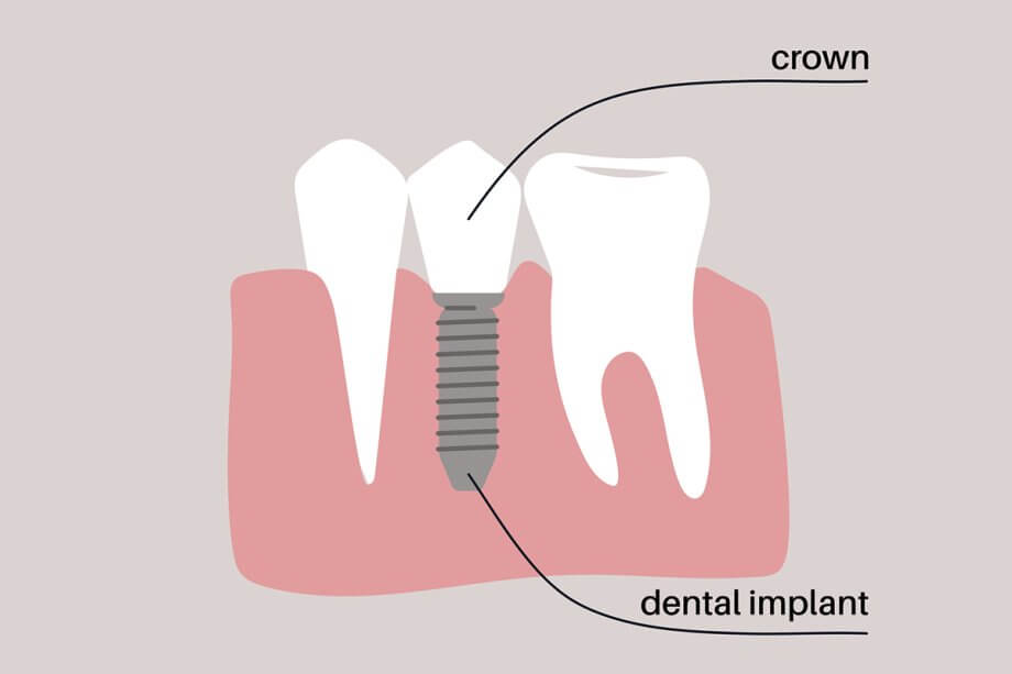 What Makes Someone a Good Candidate for Dental Implants?
